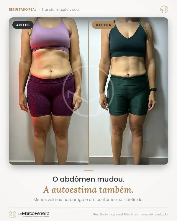 Antes e depois: O abdômen mudou. A autoestima também. Menos volume na barriga e um contorno mais definido.