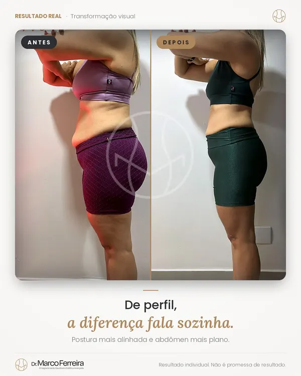 Antes e depois: De perfil, a diferença fala sozinha. Postura mais alinhada e abdômen mais plano.
