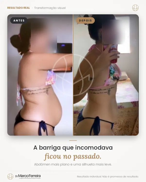 Antes e depois: A barriga que incomodava ficou no passado. Abdômen mais plano e uma silhueta mais leve.