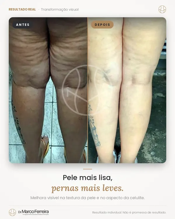 Antes e depois: Pele mais lisa, pernas mais leves. Melhora visível na textura da pele e no aspecto da celulite.